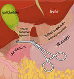 Abdominal Trauma - Spleen, Liver, Mesentery, Retroperitoneal Injury