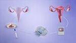 Infertility - Causes and Management