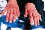 Thermal Injuries