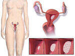 Abnormal Uterine Bleeding, Endometrial hyperplasia and Cancer