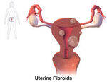 Endometriosis, Fibroid, Adenomyosis