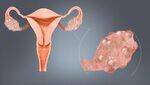 PCOS, OHSS, Hirsutism, Hysteroscopy