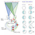 Visual field defects and Light Reflex