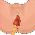 Genital cysts, Vulval Ca, Uterine Anomalies, Vaginal infections, PID, Genital TB