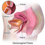 Prolapse, Stress urinary incontinence, Vesicovaginal fistula