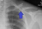 Clavicle, Shoulder, Humerus
