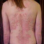 Pigmentary and Papulosquamous disorders - Psoriasis, Lichen Planus