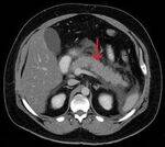 GIT Radiology - Intestine, Hepatobiliary, Pancreas