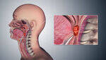 Larynx Ca, Congenital Conditions, Infections of Larynx