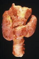 Thyroid cancer, Hyperthyroid and Hypothyroid
