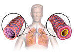 Airway Diseases - Eosinophilic lung disease, ABPA, Bronchiectasis, COPD