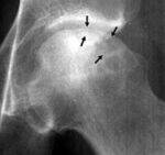 Avascular Necrosis, Fracture Mx, Prosthesis, ATLS