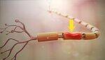 Nerve Injuries
