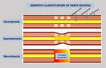 Classification, Axillary, Musculocutaneous, Median, Ulnar, Radial Nerve Injury