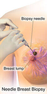 Breast basics, Investigations, Benign breast conditions