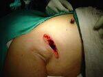 Mastectomy, SLNB, Chemotherapy, Radiotherapy, DCIS, LCIS