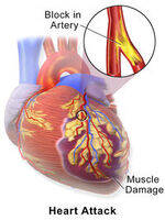 Heart Failure, Dysfunction, CP, CT
