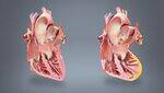 Myocardial Infarction