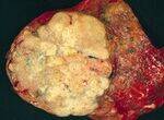 Neoplasia