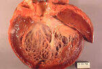 Cardiomyopathies, Arrhythmias