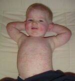 Chromosomal aneuploidies, Childhood and Congenital Infections