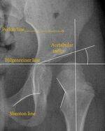 Pelvis, Hip, Femur