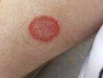 Bacterial and Fungal skin infections