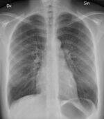 Chest X-ray Views, Basics, Interpretation