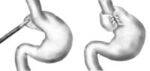 Esophagus, GERD, CA Esophagus