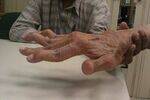 Basics, Rheumatoid arthritis