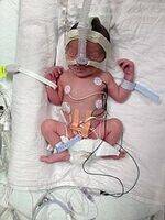 Birth Asphyxia, Preterm disorders, Neonatal Jaundice