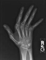 SLE, Spondyloarthritis