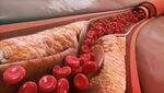 KB, FA, Cholesterol Synthesis, Lipoproteins