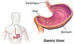 CHPS, Peptic ulcers, Gastric cancers and Malignancies