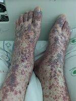 Vasculitis, Temporal, Takayasu arteritis, ANCA vasculitis, Immune complex mediated vasculitis, IgG4 related Disease