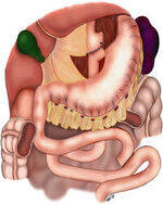 Gastric volvulus, Trichobezoar, Bariatric surgery, Mesenteric cyst