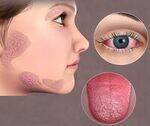 Sarcoidosis, Sjogrens, Systemic Sclerosis, Inflammatory Muscle Disease