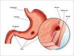 Upper GI hemorrhage, Bowel obstruction, Stricture