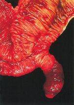 Meckels diverticulum, Hirschsprung, Mesenteric ischemia, Appendix