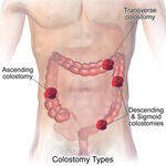 Ileostomy, Colostomy, Lower GI Haemorrhage, IBD