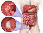 Colorectal Polyps and Cancer, Anal Cancer