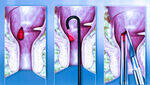 Pilonidal sinus, Haemorrhoids, Anal fissure, Perianal Abscess and Fistula, Rectal prolapse