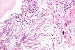 Fungi - Basics, Superficial, Subcutaneous Mycoses