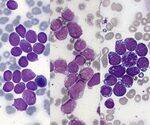 Basics, Non Neoplastic Disorders, Leukemia - ALL, AML