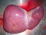 Liver Anatomy, Scores, Liver Abscess, Hydatid, Benign tumors, HCC