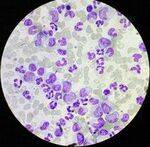 CML, Polycythemia vera, Myelofibrosis