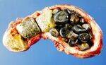 Gallbladder, Gallstones - Classifications and Presentations, EHBA