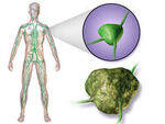 Lymphoma - HL and NHL, Multiple Myeloma, LCH
