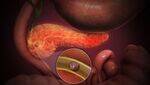 Choledochal cyst, GB Cancer, Acute and Chronic Pancreatitis, Pancreas Pseudocyst