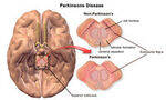 Dementia - Cortical and Subcortical, Movement Disorder - Parkinsons
